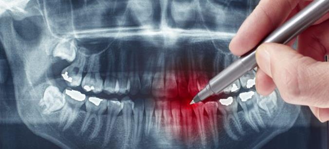 Endotontie, Endodontitis